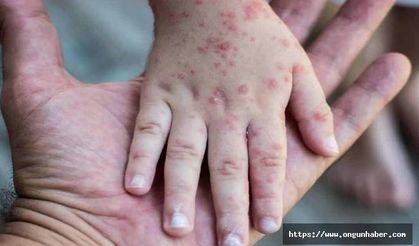 Sağlık Bakanlığı'ndan “Kızamık” Alarmı!